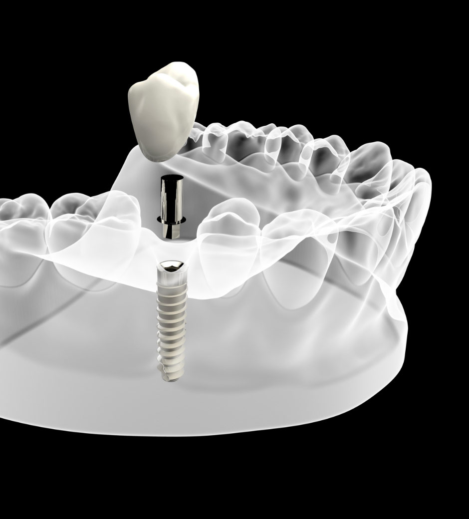 Implantologia - Studio dentistico Stoffella - dentista a Rovereto