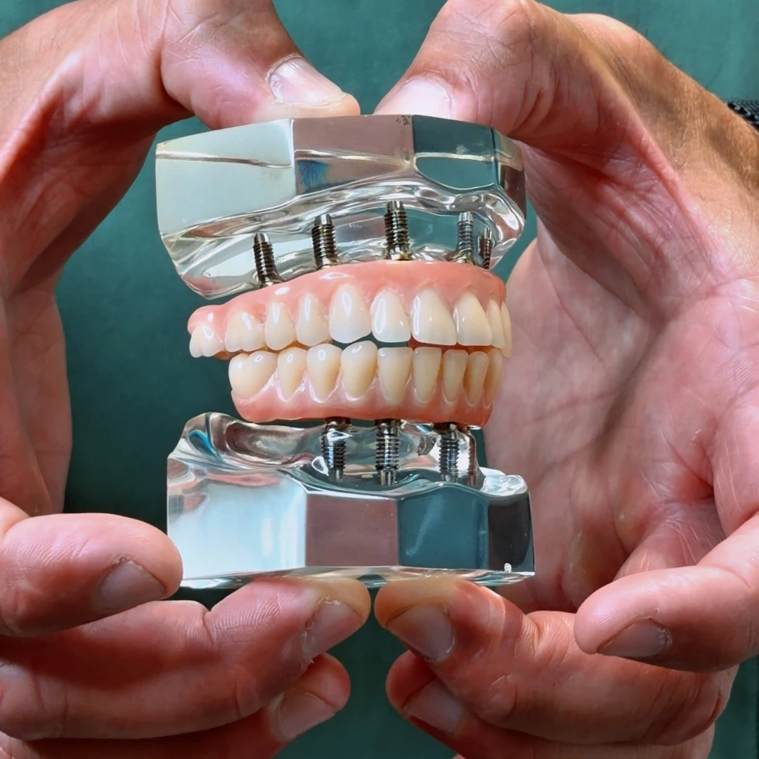 protesi fissa e dentiera a Rovereto - Protesi dentale mobile o impianti