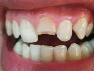 dente rotto improvvisamente