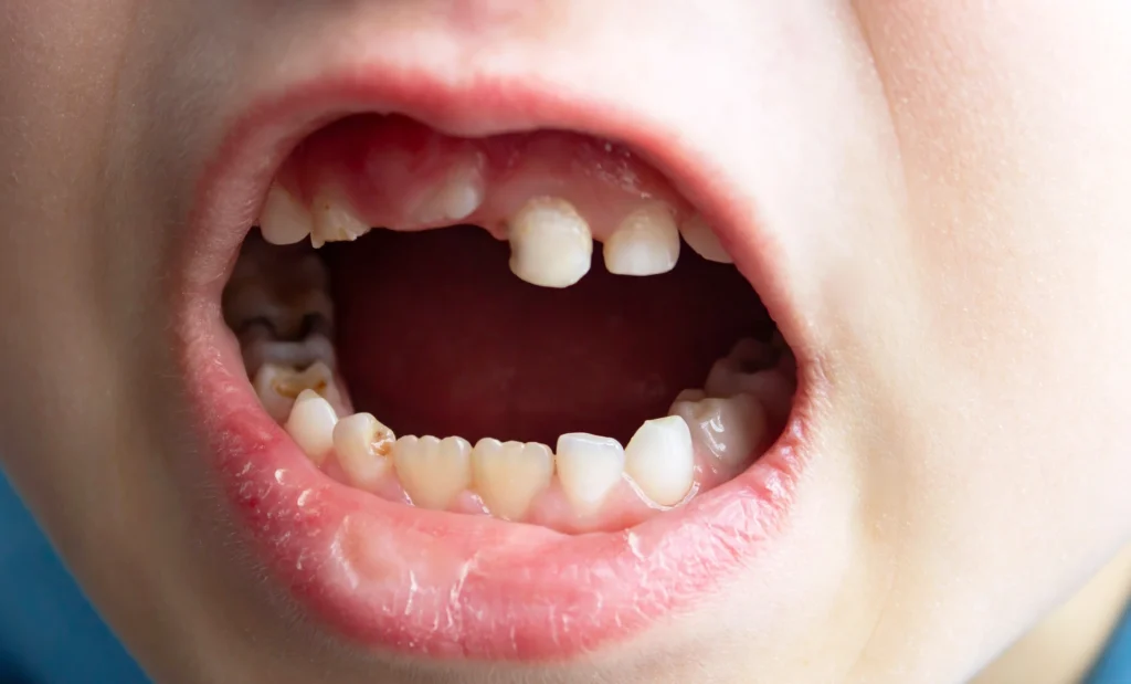 denti da latte cariati