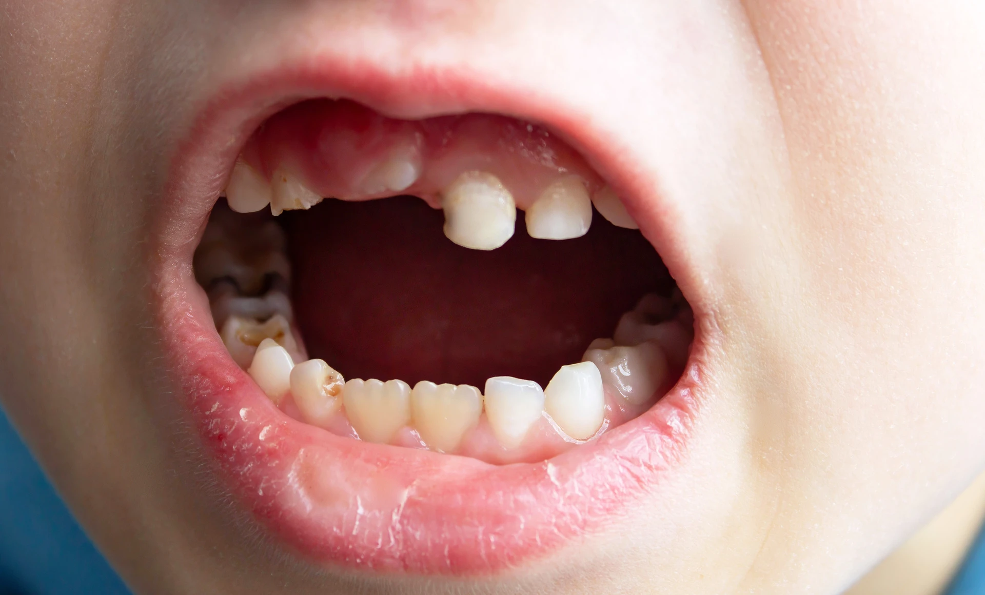 denti da latte cariati