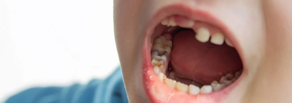 denti da latte cariati