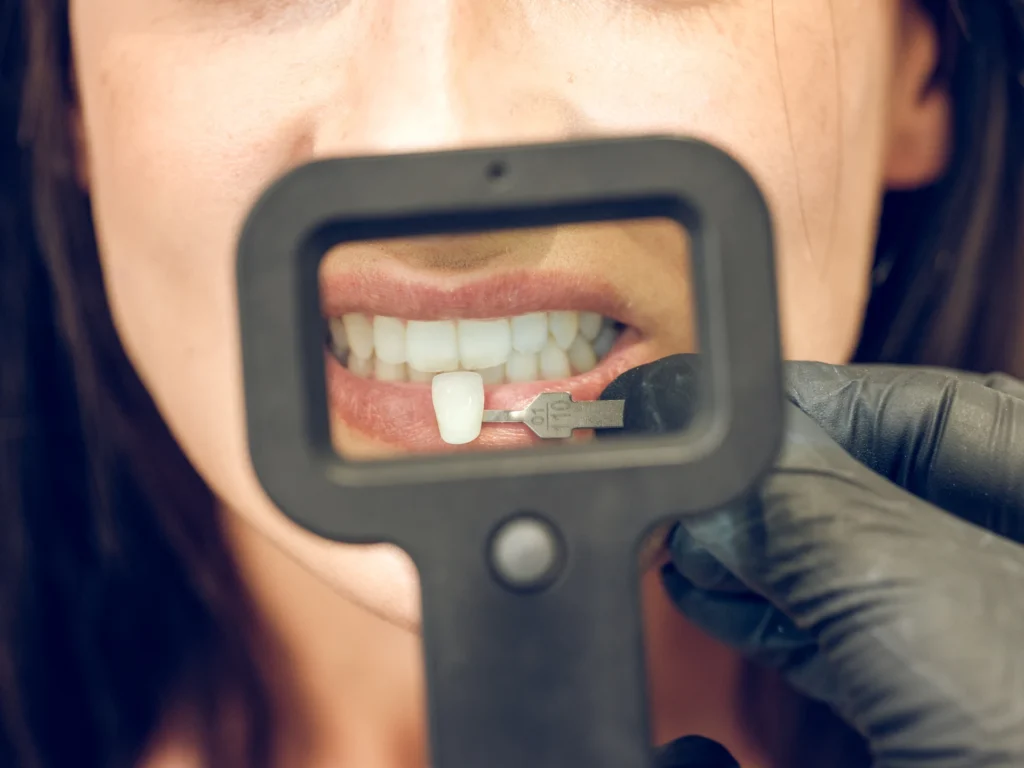 Le faccette dentali si rovinano con il tempo? - Studio dentistico Stoffella - dentista Rovereto faccette dentali si rovinano