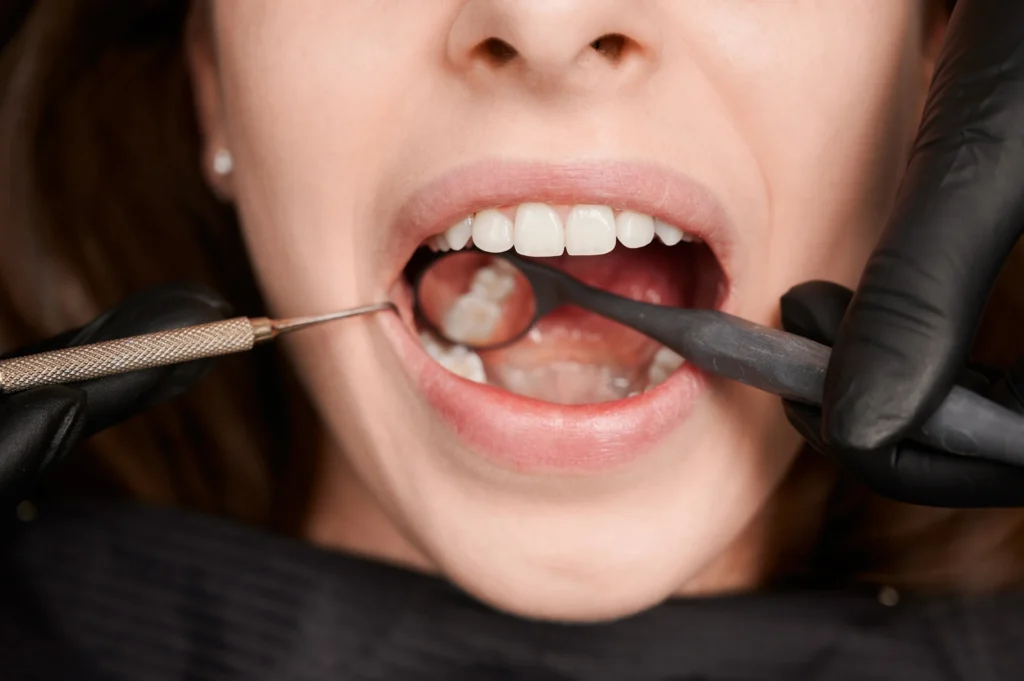 dente rotto improvvisamente