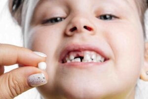 quando cadono i denti da latte - Studio dentistico Stoffella - dentista Rovereto