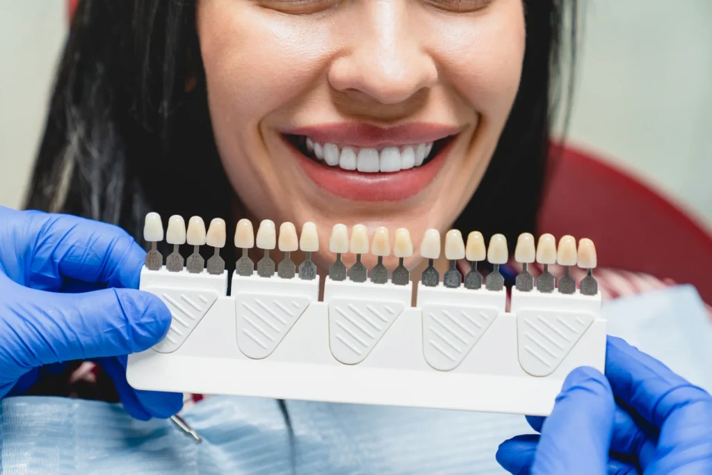 faccette dentali si rovinano