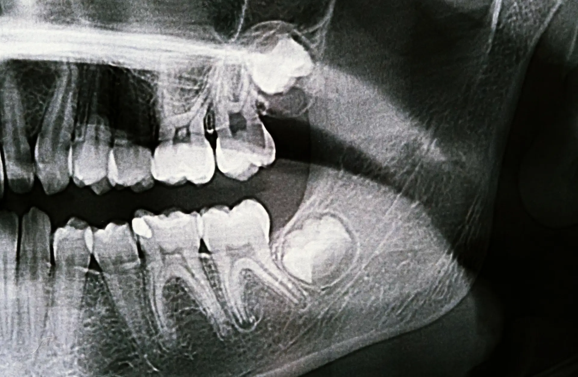 paura di togliere il dente del giudizio